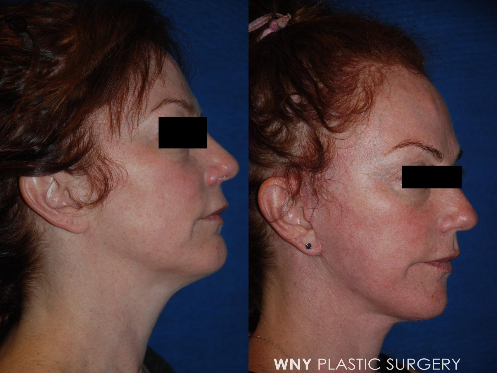 Before & After Facelift Case 189 Right Side View in Williamsville, NY