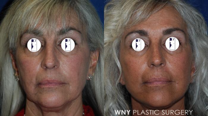 Before & After Facelift Case 192 Front View in Williamsville, NY