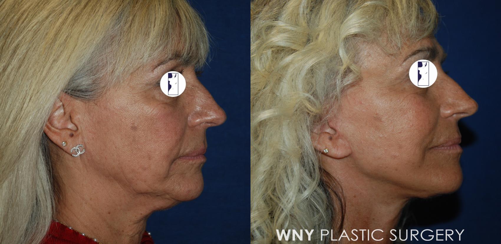 Before & After Facelift Case 192 Left Side View in Williamsville, NY