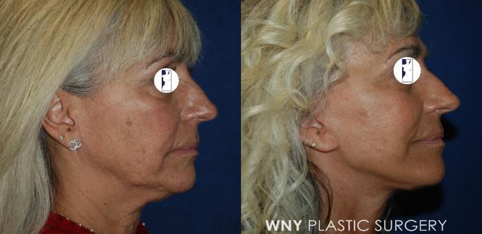 Before & After Facelift Case 192 Left Side View in Buffalo, NY