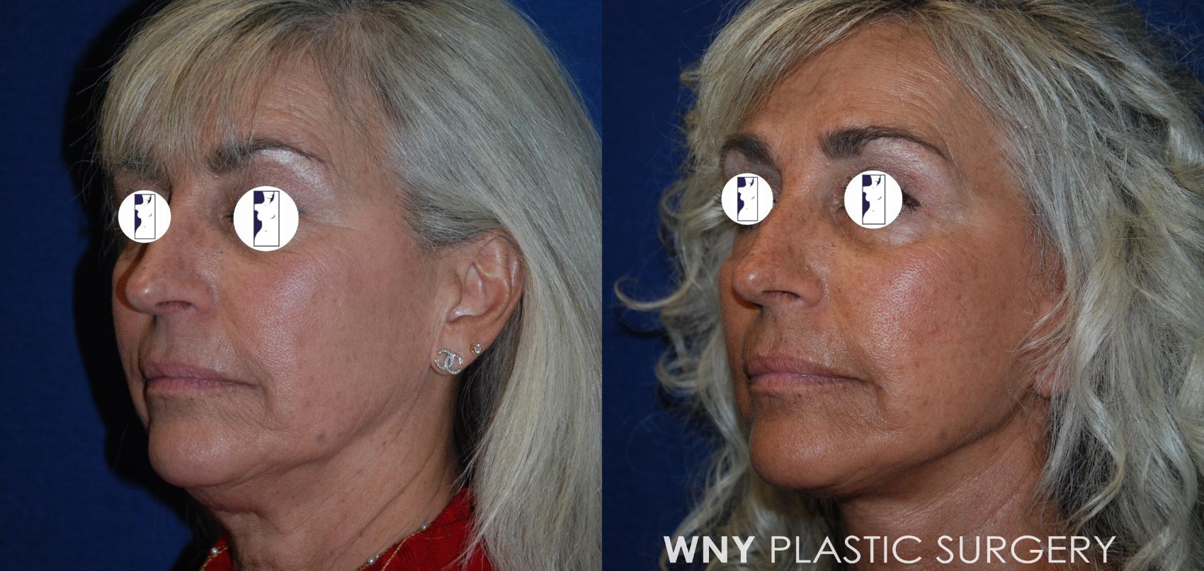 Before & After Facelift Case 192 Right Oblique View in Williamsville, NY