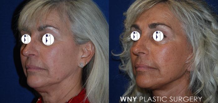 Before & After Facelift Case 192 Right Oblique View in Buffalo, NY