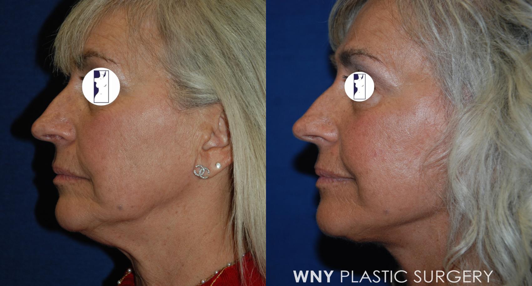 Before & After Facelift Case 192 Right Side View in Williamsville, NY