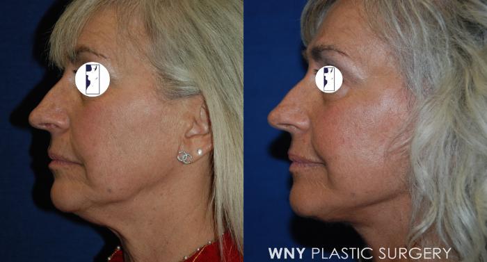Before & After Facelift Case 192 Right Side View in Buffalo, NY