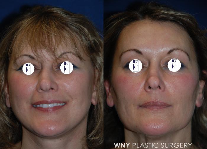 Before & After Facelift Case 199 Front View in Williamsville, NY