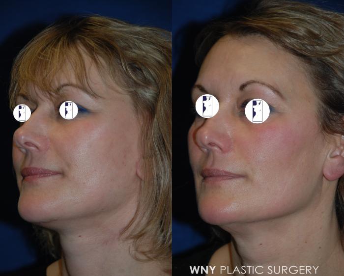 Before & After Facelift Case 199 Left Oblique View in Williamsville, NY