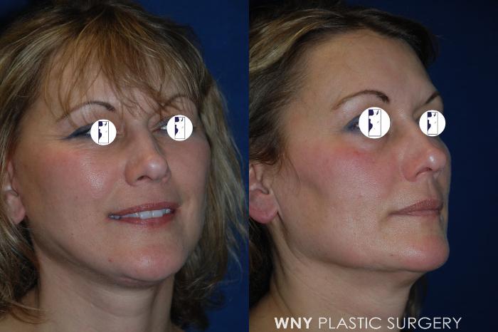 Before & After Facelift Case 199 Right Oblique View in Williamsville, NY
