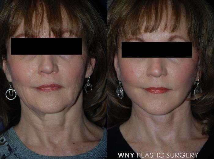 Before & After Facelift Case 20 View #1 View in Williamsville, NY