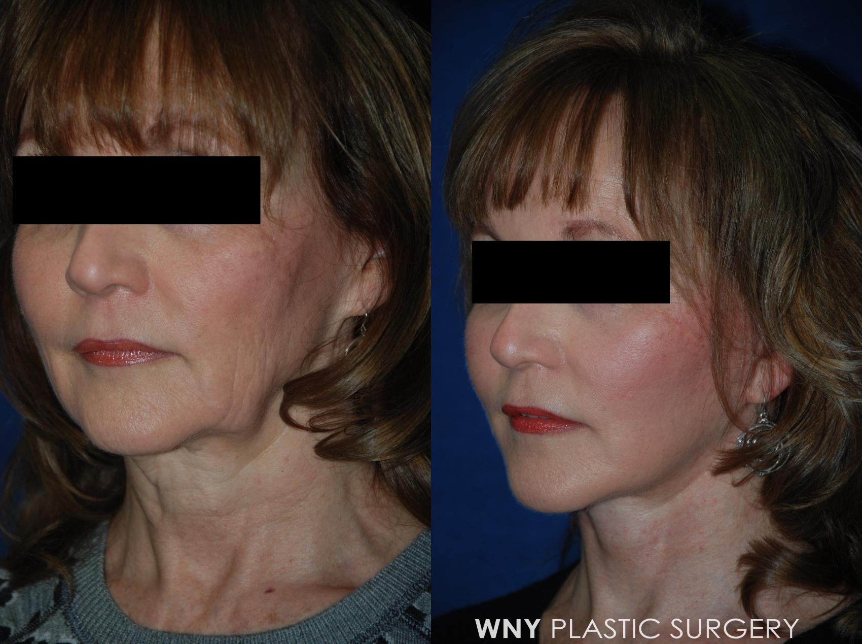 Before & After Facelift Case 20 View #2 View in Williamsville, NY