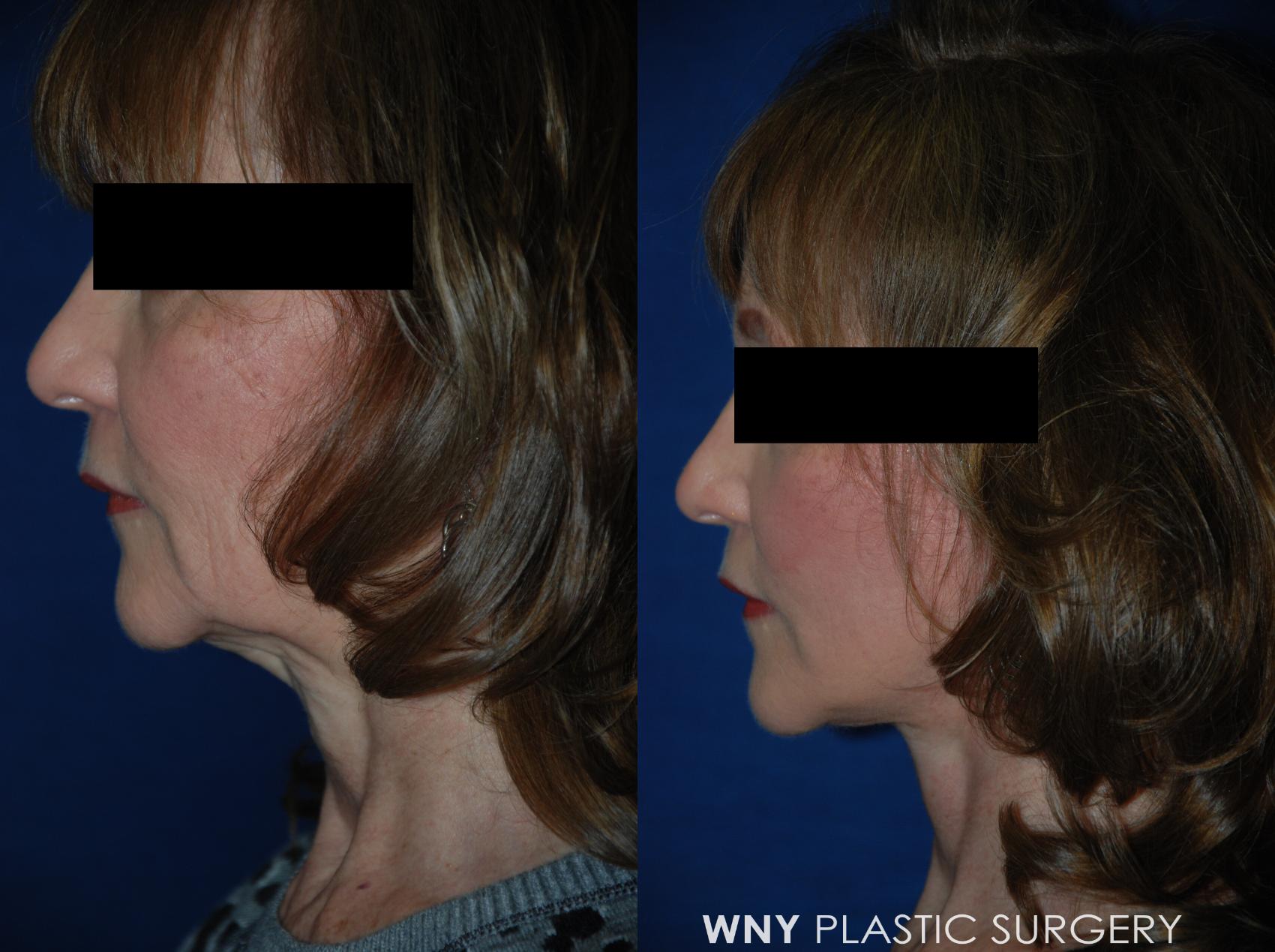 Before & After Facelift Case 20 View #3 View in Williamsville, NY