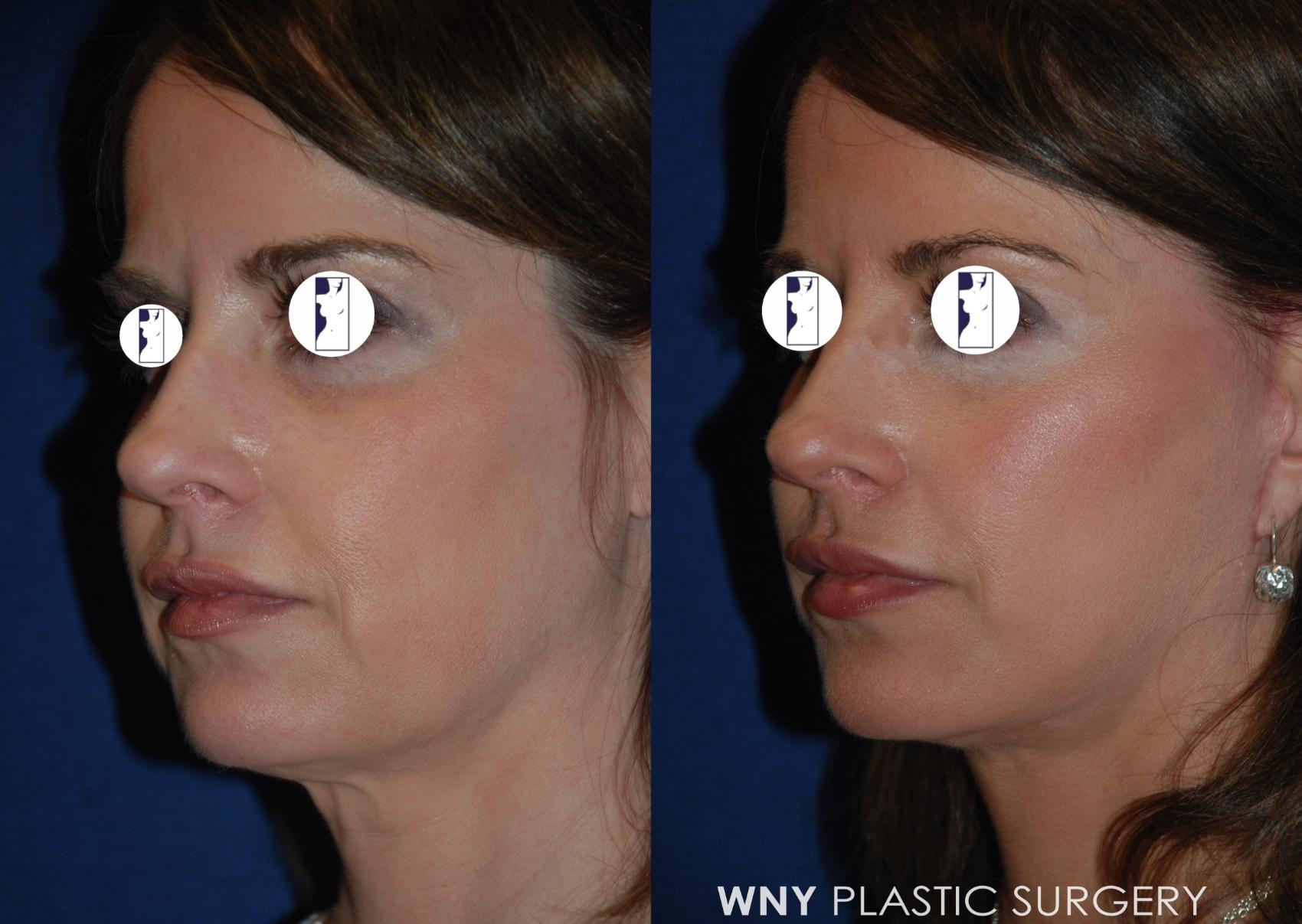 Before & After Facelift Case 200 Left Oblique View in Williamsville, NY