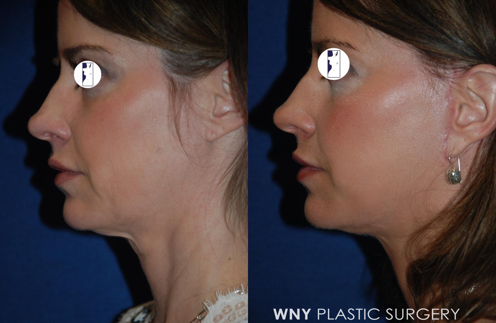 Before & After Facelift Case 200 Left Side View in Williamsville, NY