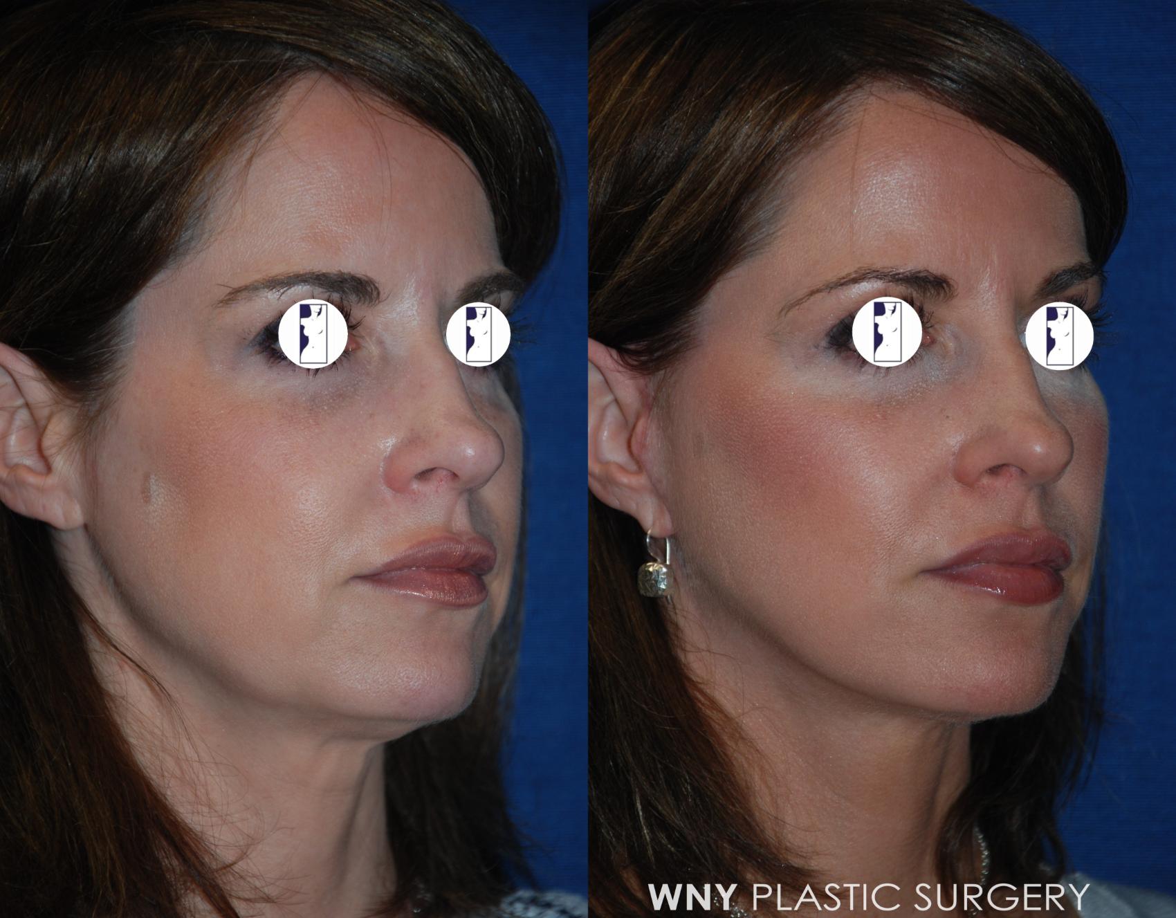 Before & After Facelift Case 200 Right Oblique View in Williamsville, NY