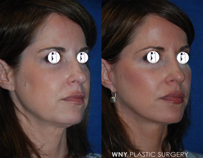 Before & After Facelift Case 200 Right Oblique View in Williamsville, NY