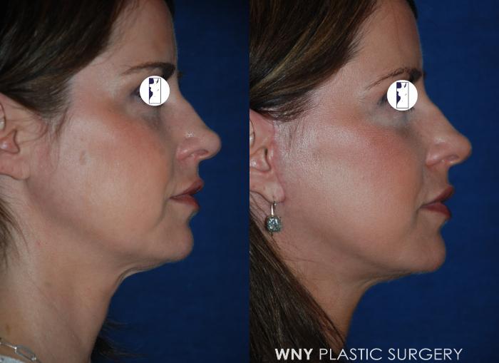 Before & After Facelift Case 200 Right Side View in Williamsville, NY