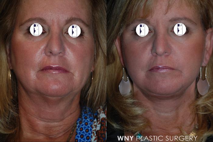 Before & After Facelift Case 211 Front View in Williamsville, NY