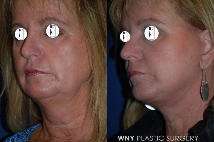 Before & After Facelift Case 211 Left Oblique View in Williamsville, NY