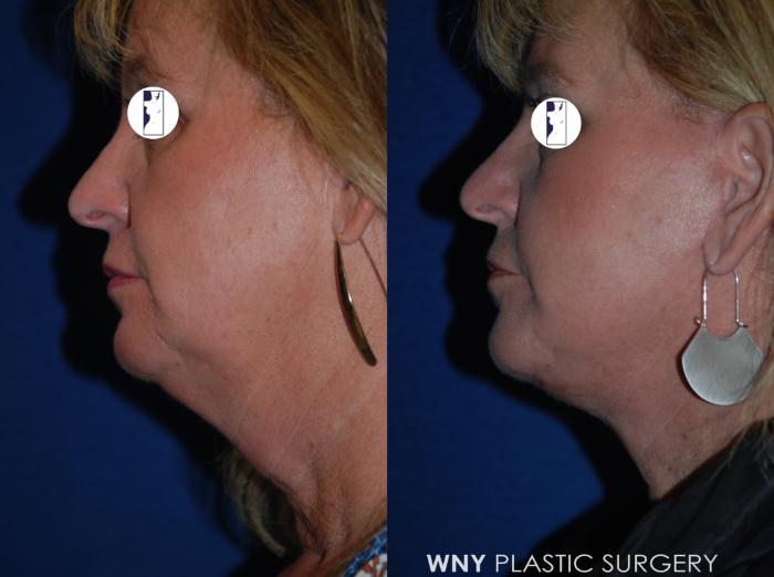 Before & After Facelift Case 211 Left Side View in Williamsville, NY