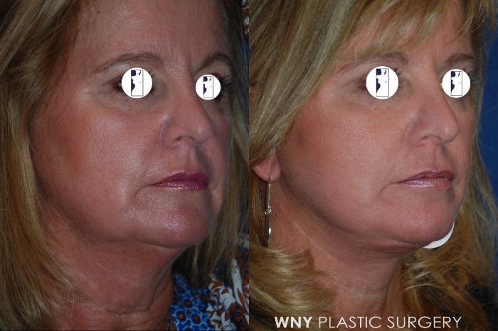 Before & After Facelift Case 211 Right Oblique View in Williamsville, NY