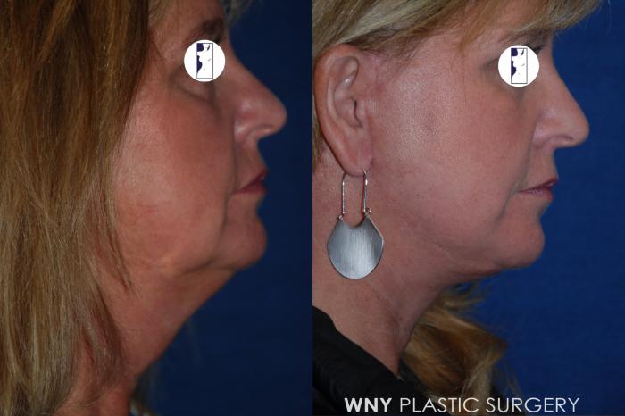 Before & After Facelift Case 211 Right Side View in Williamsville, NY
