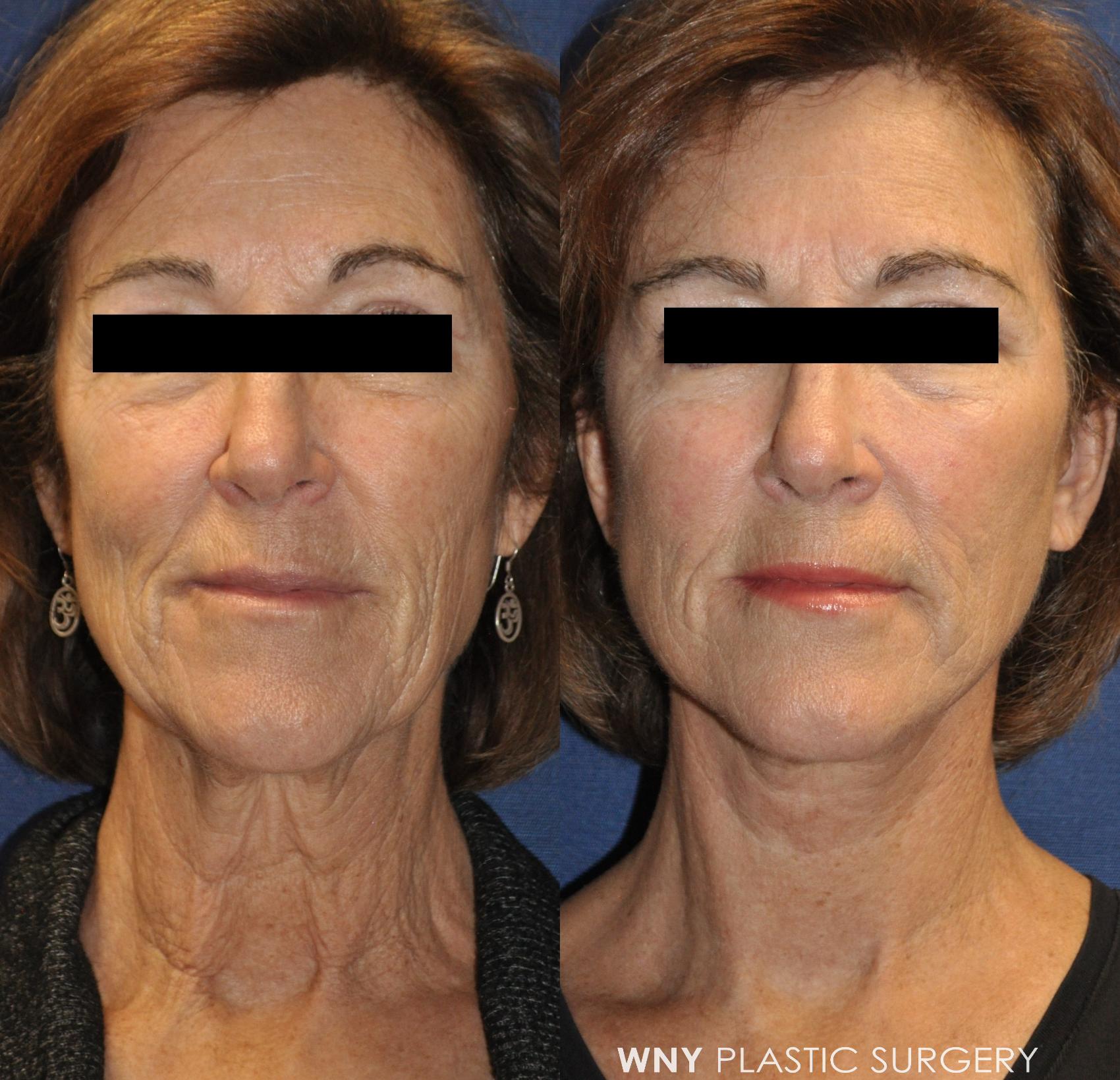 Before & After Facelift Case 234 Front View in Buffalo, NY