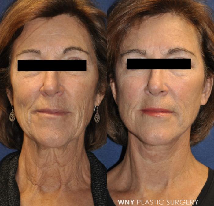 Before & After Facelift Case 234 Front View in Buffalo, NY
