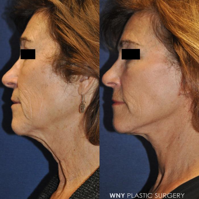 Before & After Facelift Case 234 Left Side View in Buffalo, NY