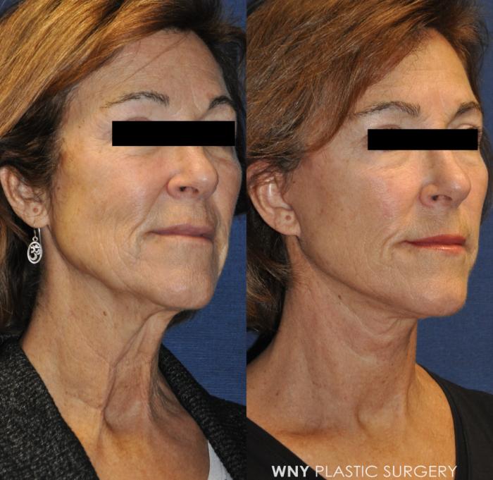 Before & After Facelift Case 234 Right Oblique View in Buffalo, NY