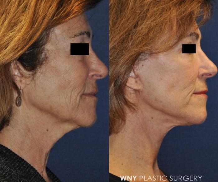 Before & After Facelift Case 234 Right Side View in Buffalo, NY