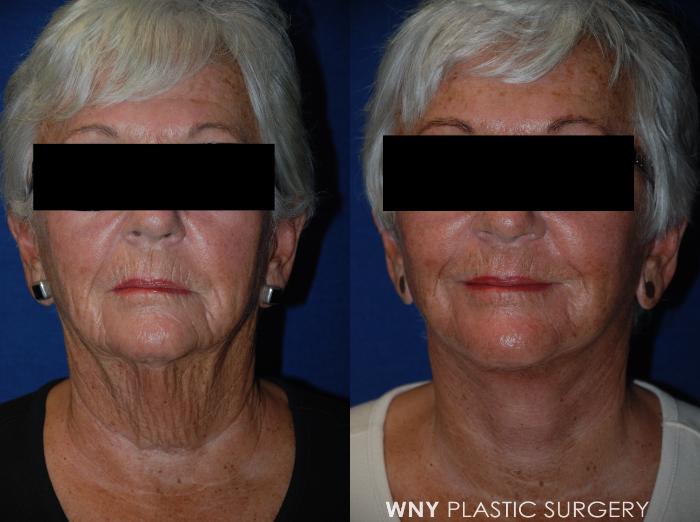 Before & After Facelift Case 36 View #1 View in Williamsville, NY