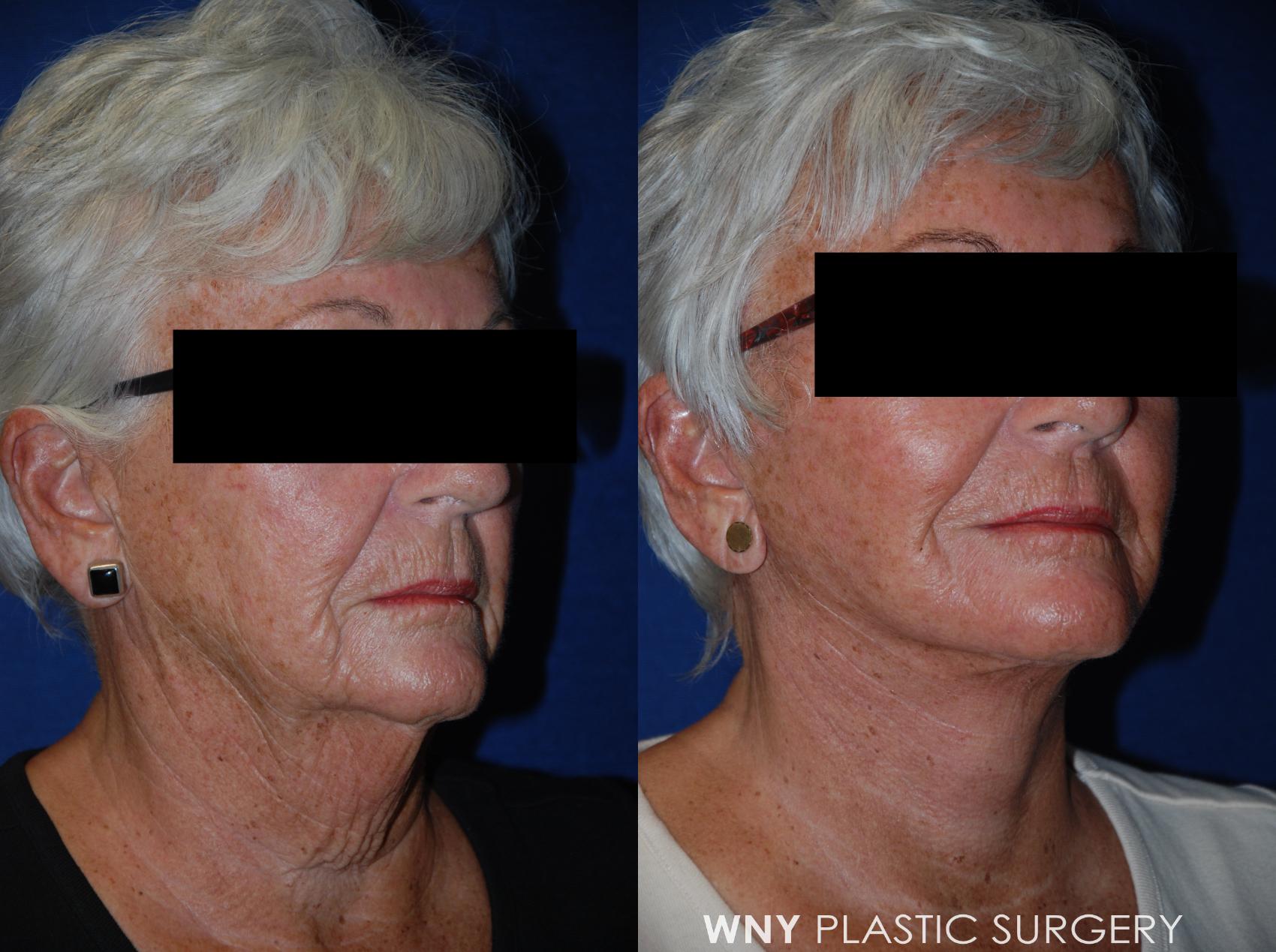 Before & After Facelift Case 36 View #2 View in Williamsville, NY