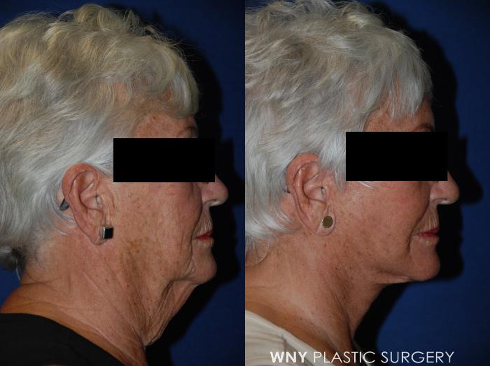 Before & After Facelift Case 36 View #3 View in Buffalo, NY