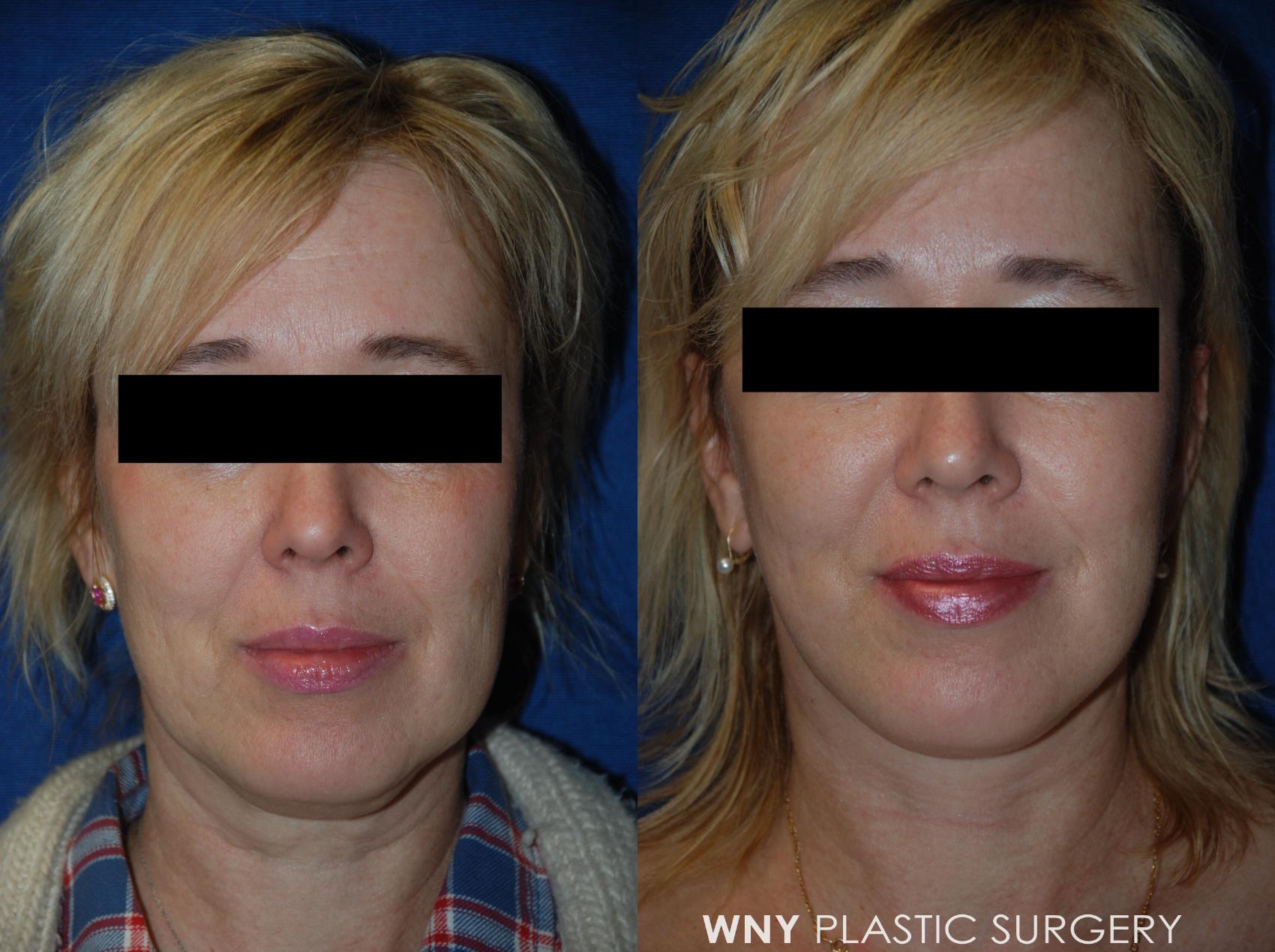 Before & After Facelift Case 53 View #1 View in Williamsville, NY