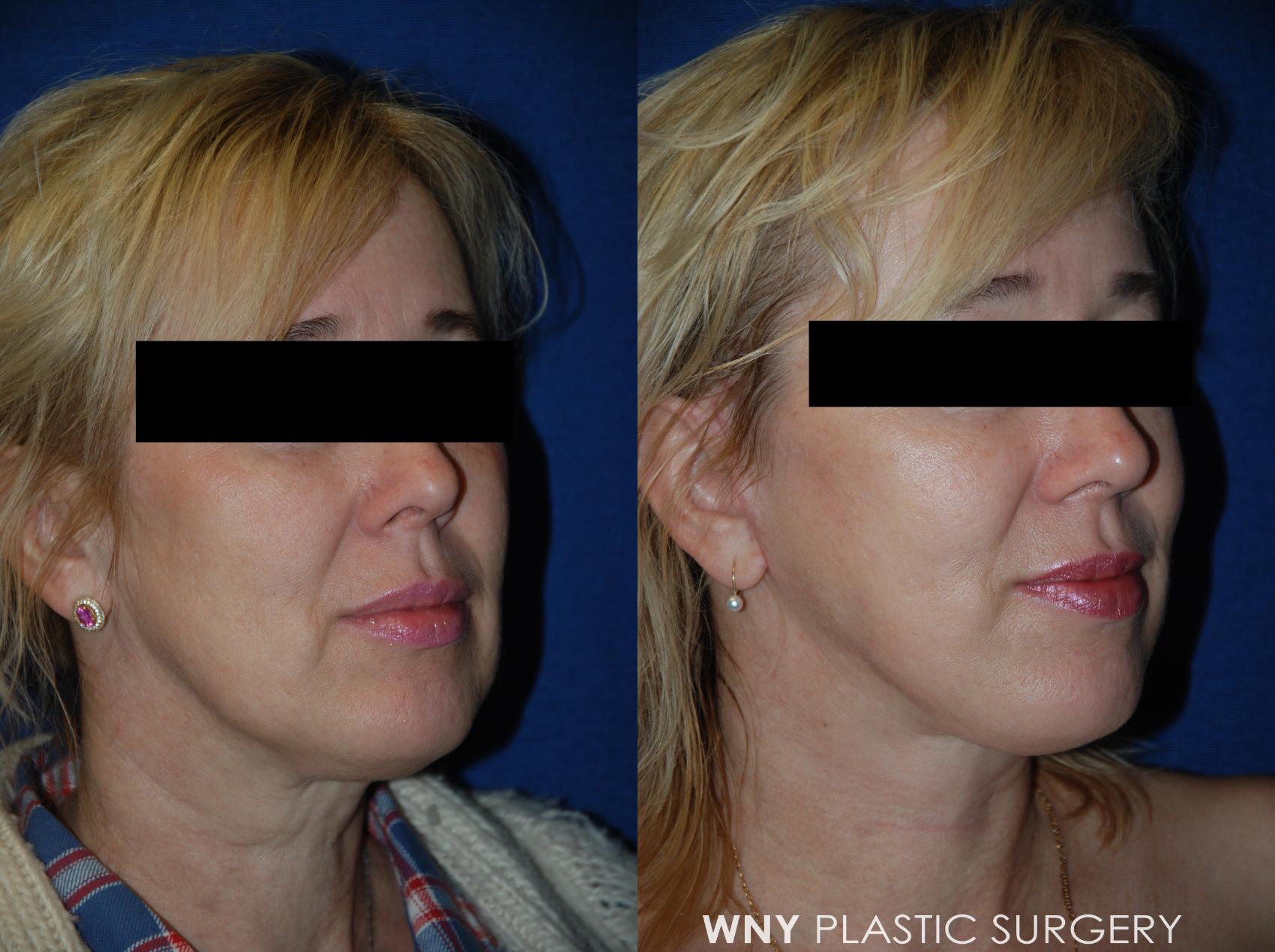 Before & After Facelift Case 53 View #2 View in Williamsville, NY