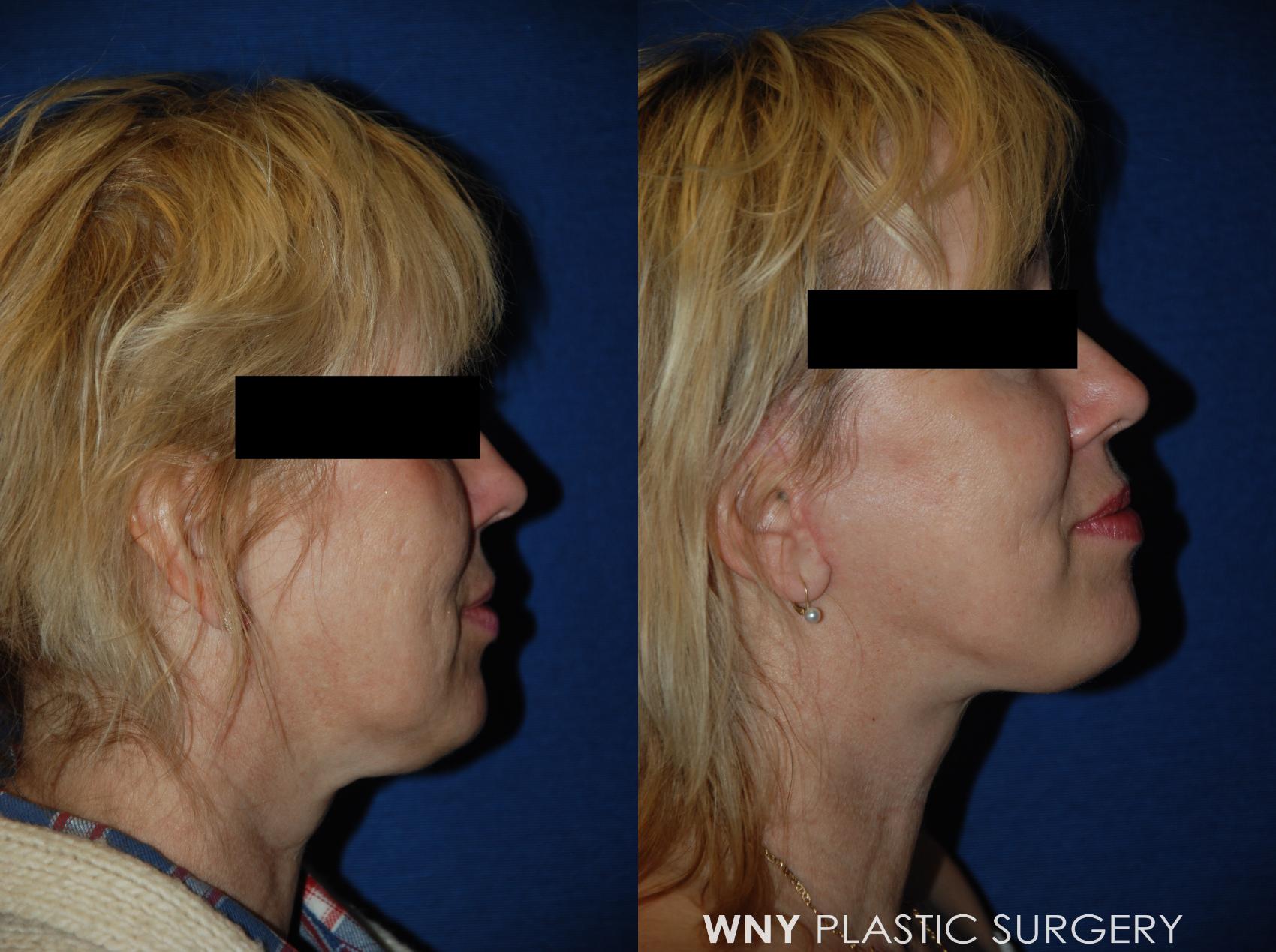 Before & After Facelift Case 53 View #3 View in Williamsville, NY