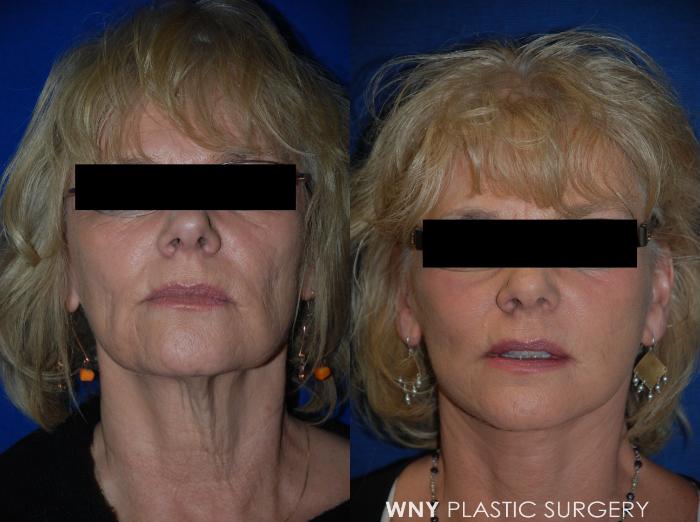 Before & After Facelift Case 65 View #1 View in Williamsville, NY