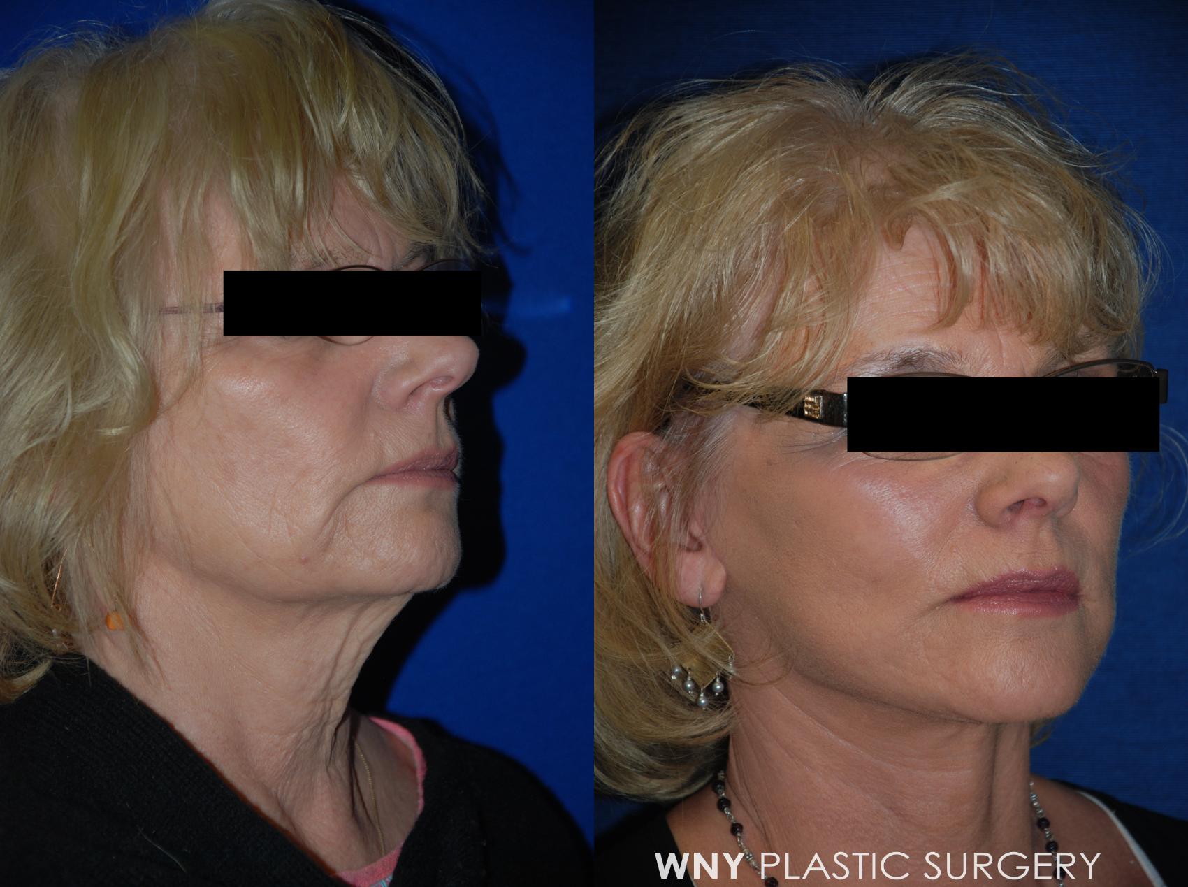 Before & After Facelift Case 65 View #2 View in Williamsville, NY