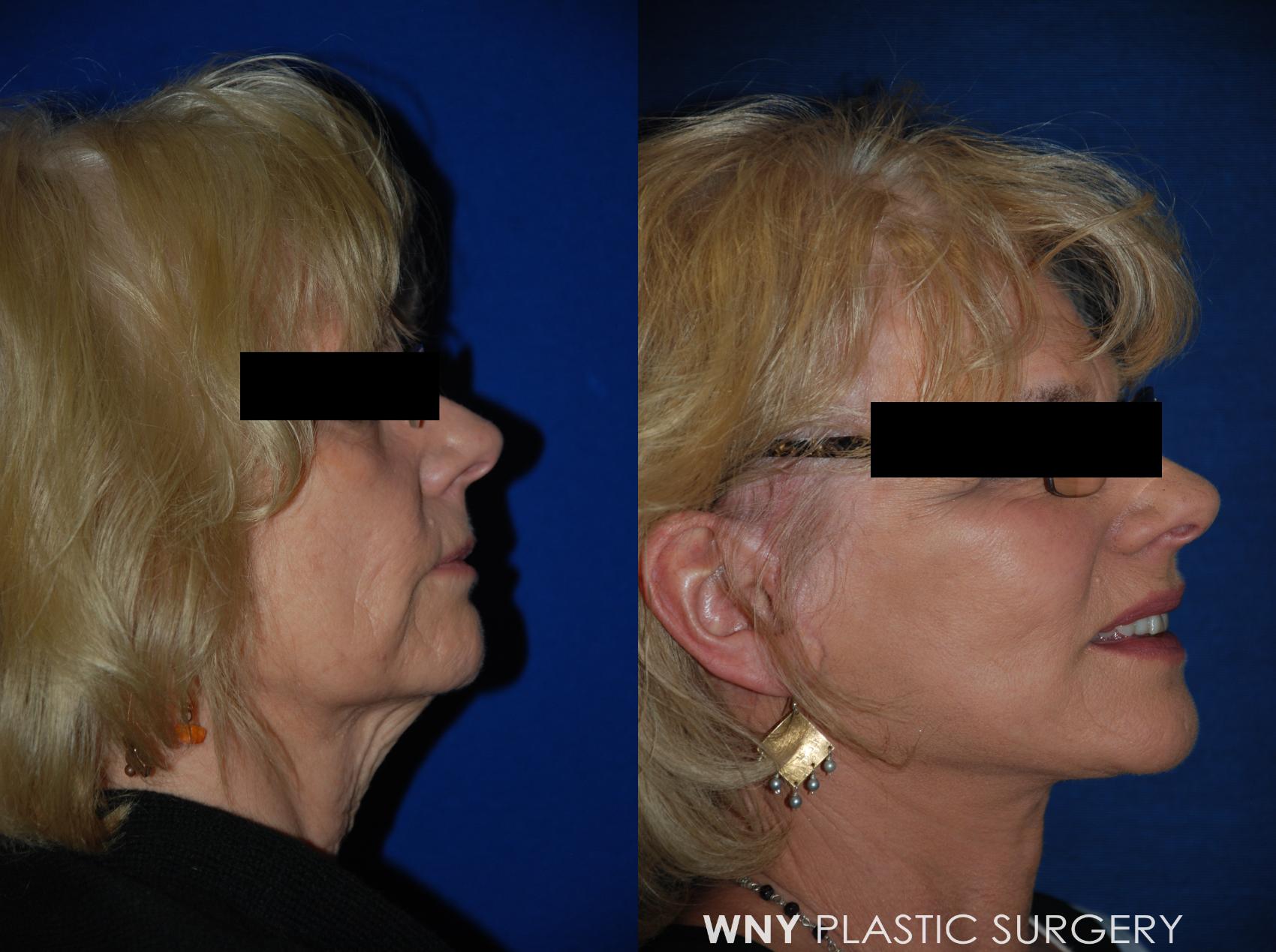 Before & After Facelift Case 65 View #3 View in Williamsville, NY