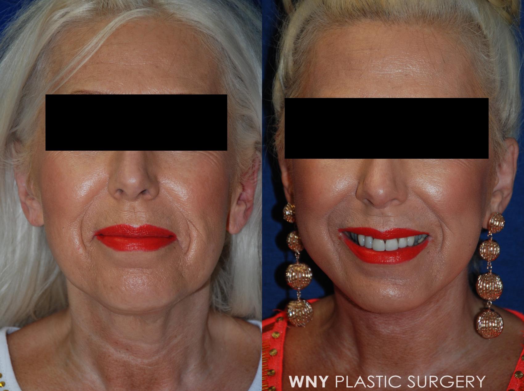 Before & After Facelift Case 95 View #1 View in Williamsville, NY