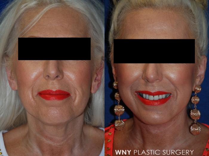 Before & After Facelift Case 95 View #1 View in Buffalo, NY