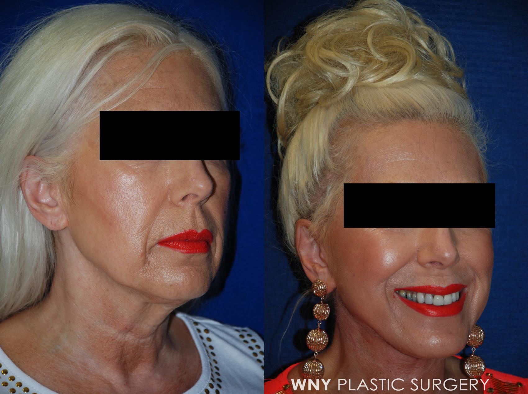 Before & After Facelift Case 95 View #2 View in Williamsville, NY