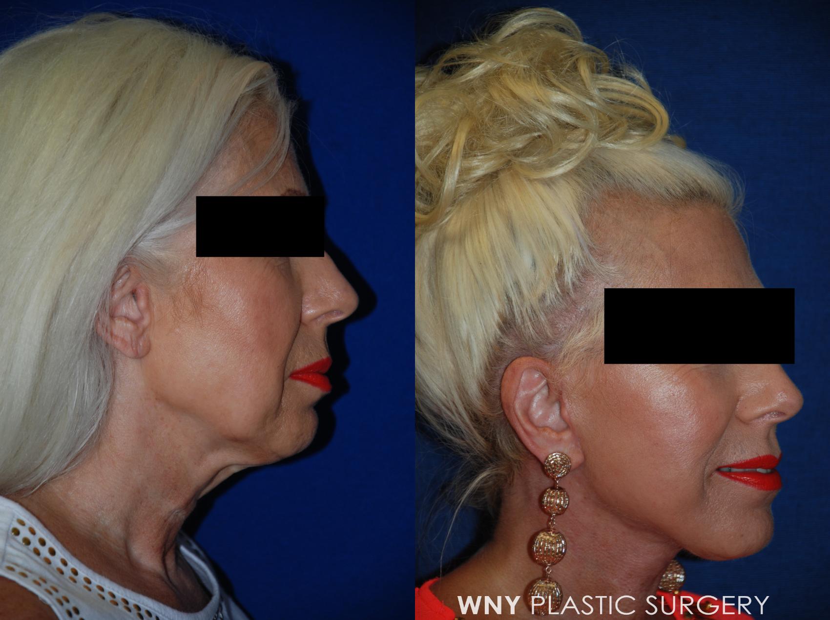 Before & After Facelift Case 95 View #3 View in Williamsville, NY
