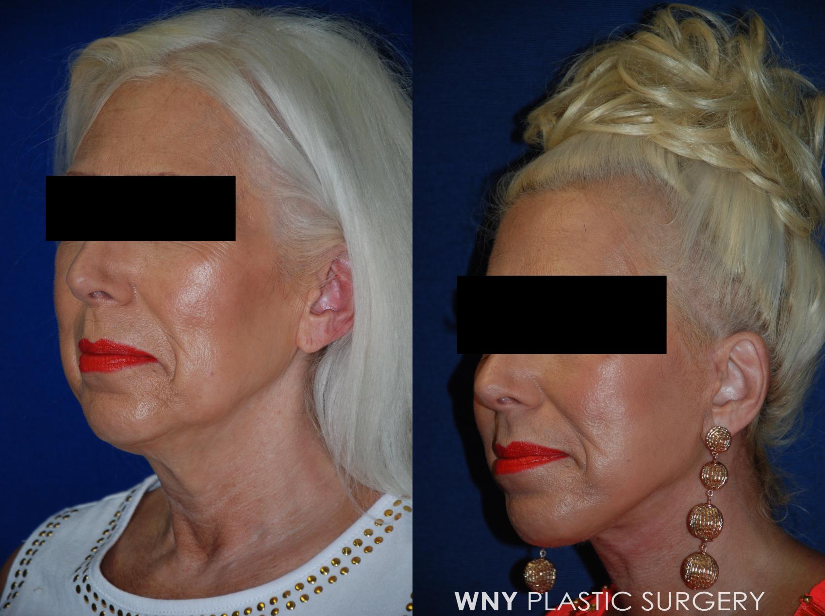 Before & After Facelift Case 95 View #4 View in Williamsville, NY