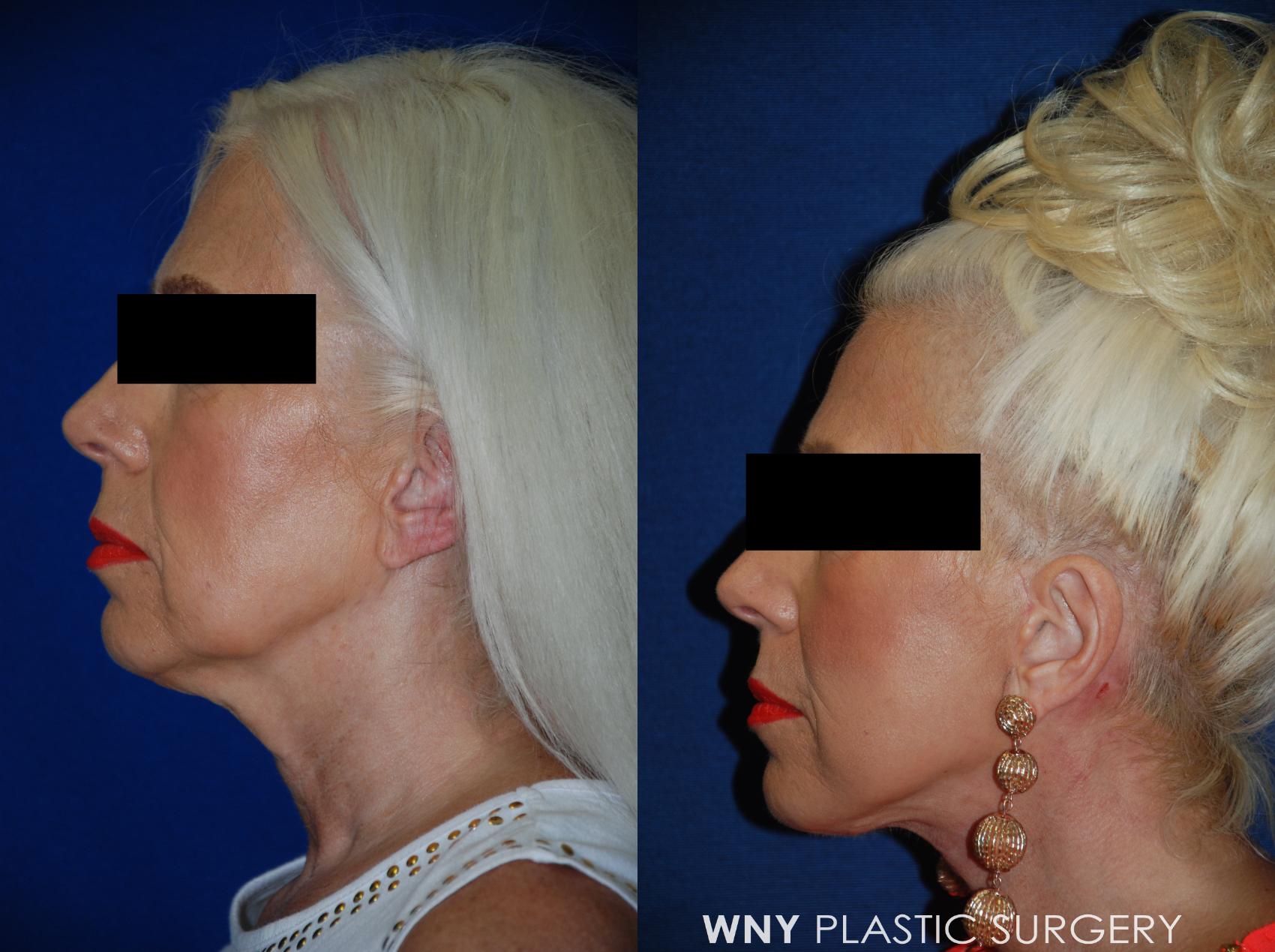 Before & After Facelift Case 95 View #5 View in Williamsville, NY