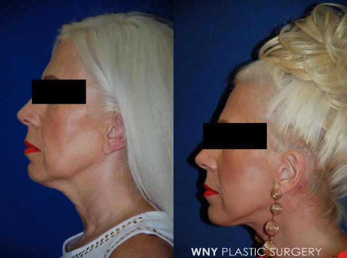 Before & After Facelift Case 95 View #5 View in Buffalo, NY
