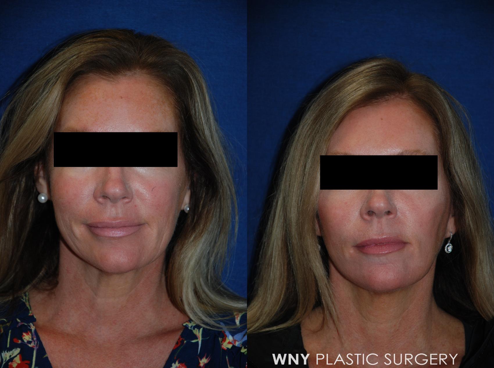 Before & After Facelift Case 99 View #1 View in Williamsville, NY