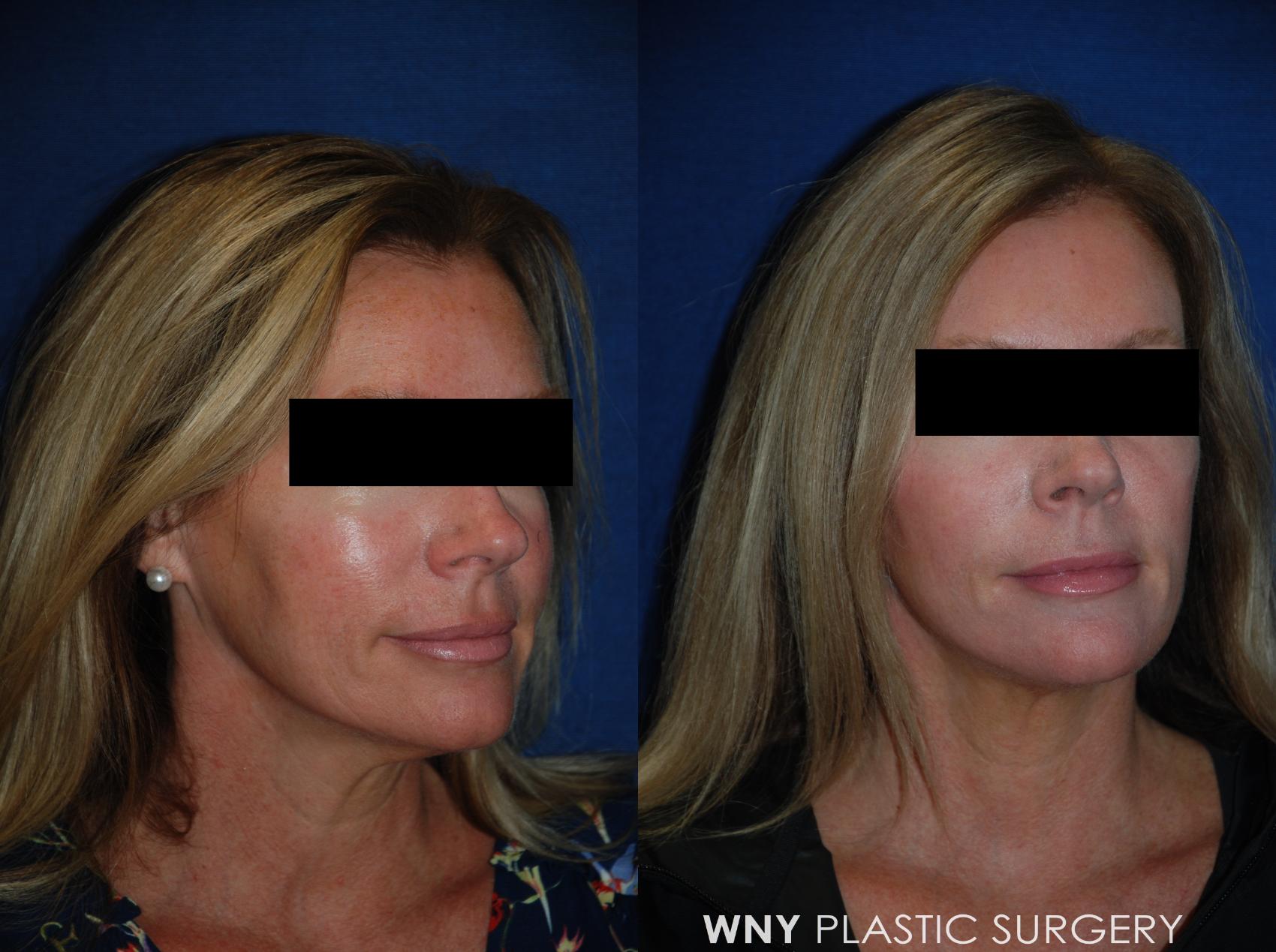 Before & After Facelift Case 99 View #2 View in Williamsville, NY