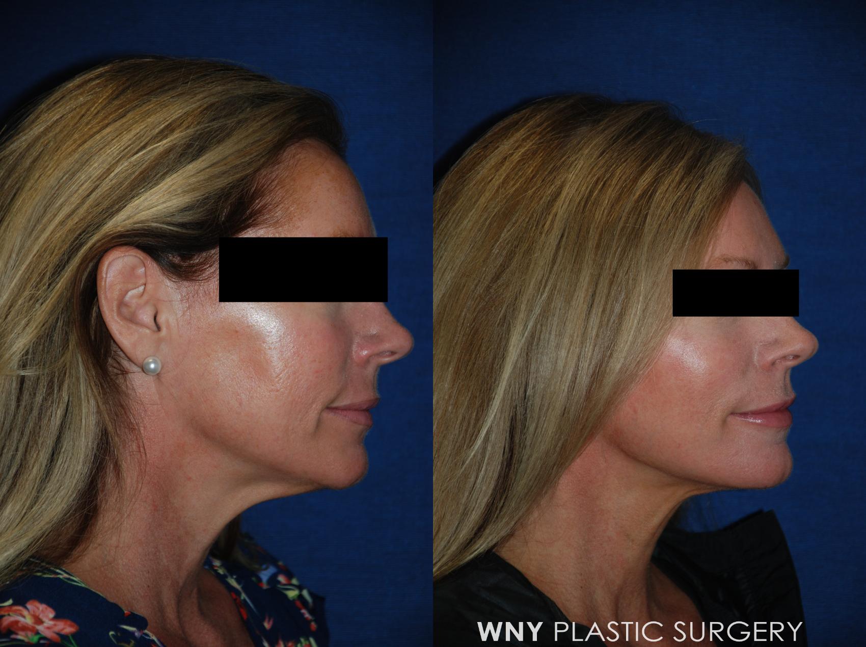 Before & After Facelift Case 99 View #3 View in Williamsville, NY