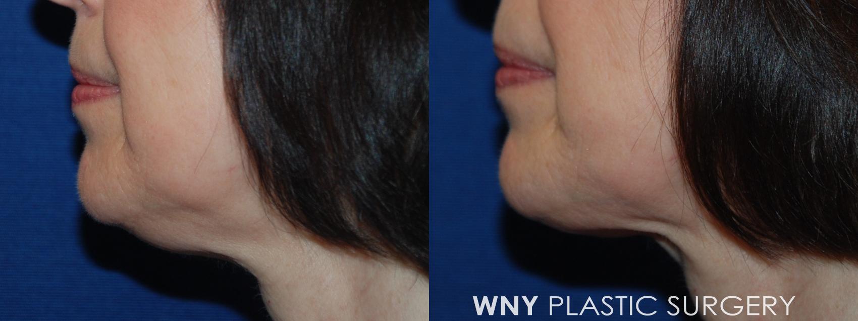 Before & After KYBELLA Case 125 Left Side View in Williamsville, NY
