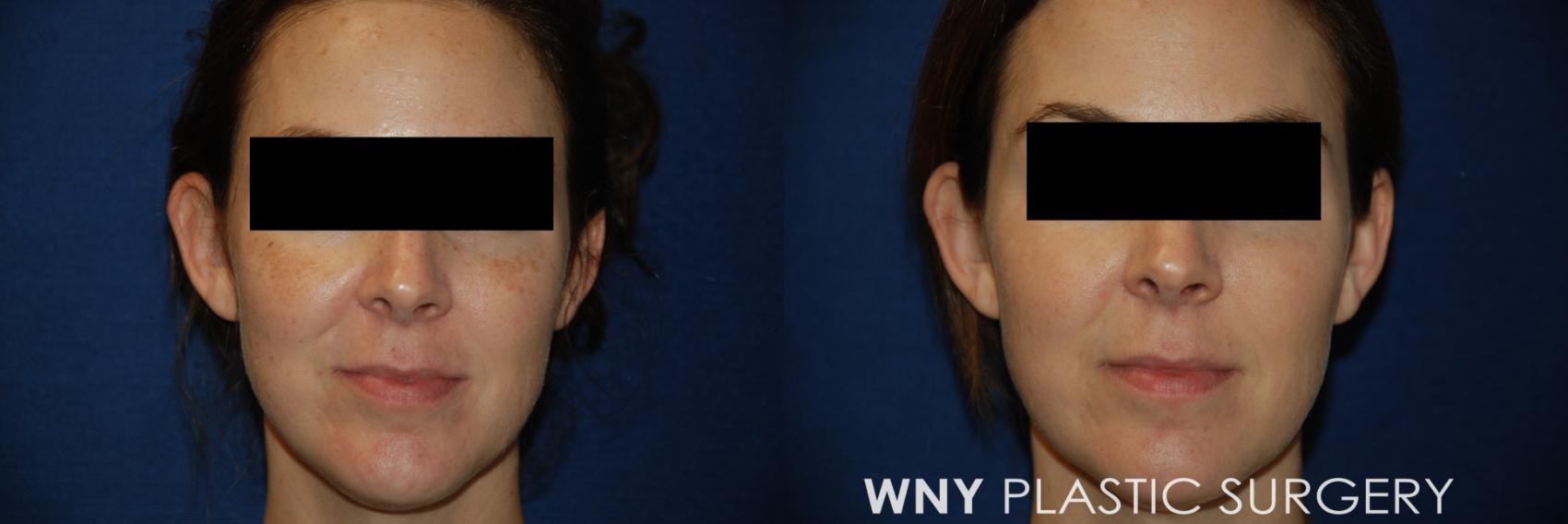Before & After Laser Treatments Case 103 Front View in Williamsville, NY